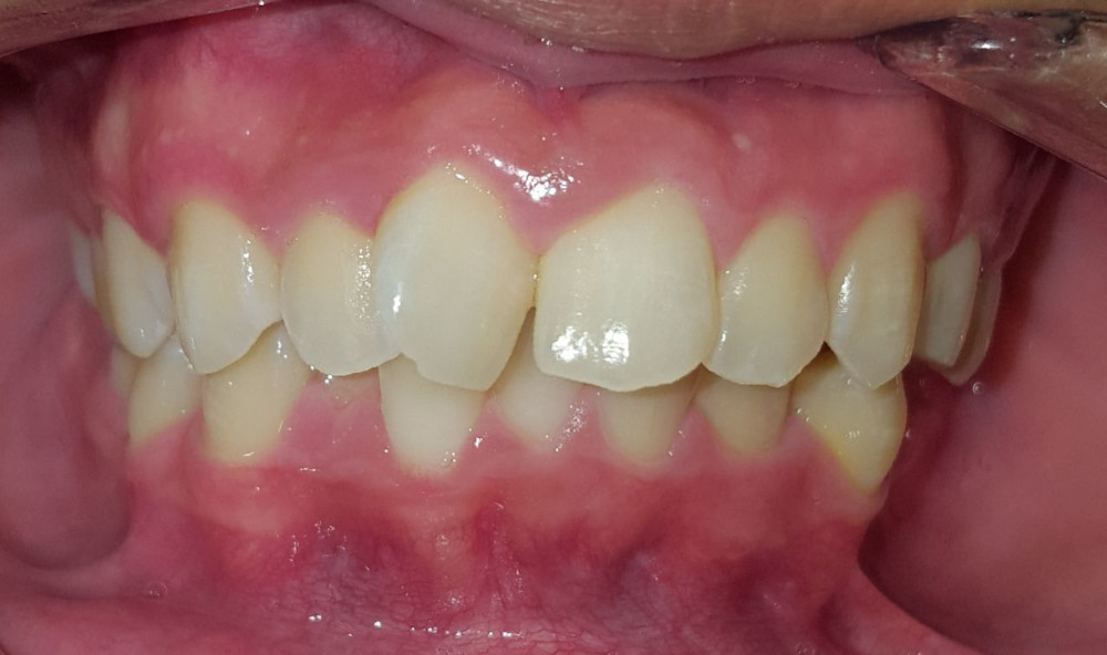 Orthodontic Treatments Before & After