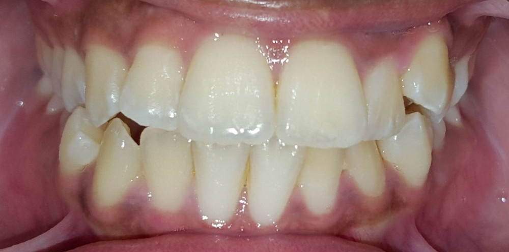 Orthodontic Treatments Before & After