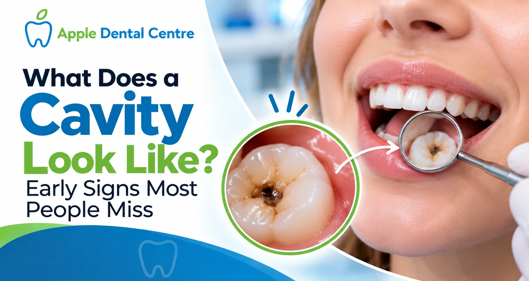 What Does a Cavity Look Like Early Signs Most People Miss apple dental centre